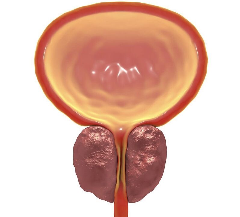 Inflammation of chronic prostatitis