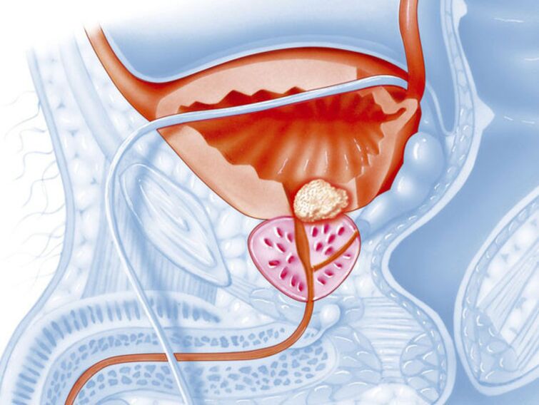 Symptoms of chronic prostatitis