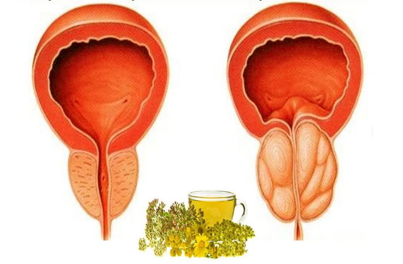 Healthy and aching prostate